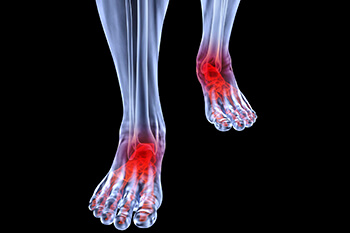 Arthritic foot and ankle care treatment, foot arthritis treatment in the Port St Lucie, FL 34952, Stuart, FL 34994 and Hollywood, FL, 33021 areas