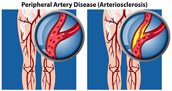 Clogged Artery Model, English-Spanish