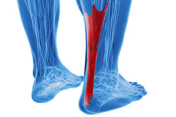 Achilles tendonitis treatment in the Port St Lucie, FL 34952, Stuart, FL 34994 and Hollywood, FL, 33021 areas