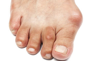 Bunions treatment in the Port St Lucie, FL 34952, Stuart, FL 34994 and Hollywood, FL, 33021 areas