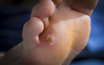 Corns treatment in Port St. Lucie, Stuart & Hollywood, FL corns treatment in the Port St Lucie, FL 34952, Stuart, FL 34994 and Hollywood, FL, 33021 areas