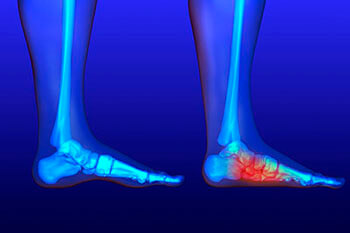 Flat feet and Fallen Arches treatment, Flatfoot Deformity Treatment in the Port St Lucie, FL 34952, Stuart, FL 34994 and Hollywood, FL, 33021 areas