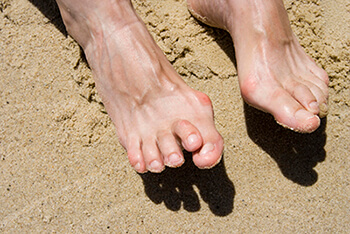 Hammertoes & Mallet Toes treatment in the Port St Lucie, FL 34952, Stuart, FL 34994 and Hollywood, FL, 33021 areas