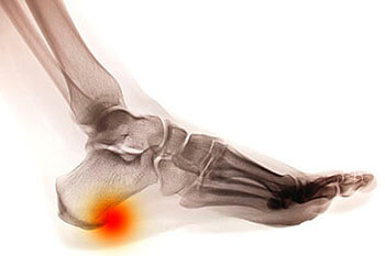 Heel spurs treatment in the Port St Lucie, FL 34952, Stuart, FL 34994 and Hollywood, FL, 33021 areas