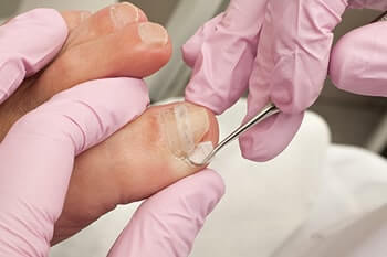 Ingrown toenails treatment in the Port St Lucie, FL 34952, Stuart, FL 34994 and Hollywood, FL, 33021 areas