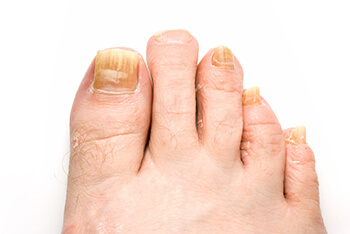 Fungal toenails, toenail fungus diagnosis and treatment in the Port St Lucie, FL 34952, Stuart, FL 34994 and Hollywood, FL, 33021 areas