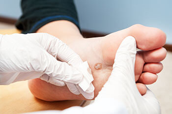 Plantar Warts Treatment Plantar warts treatment in the Port St Lucie, FL 34952, Stuart, FL 34994 and Hollywood, FL, 33021 areas