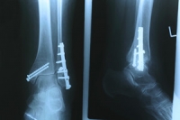Surgery for Ankle Fractures
