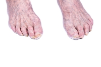Common Foot Problems Among Seniors